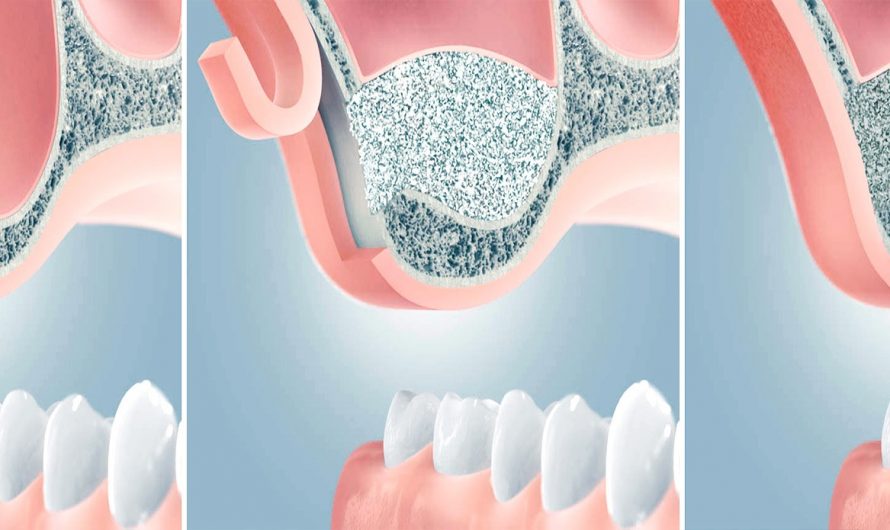 Синус-лифтинг: что нужно знать об этой стоматологической процедуре