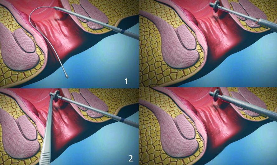 Лазерная Операция по Удалению Свищей Прямой Кишки: современный подход к лечению